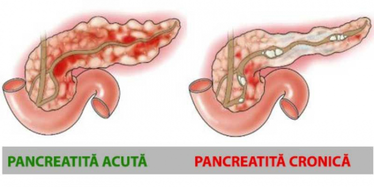 Pancreatita acută și cronică